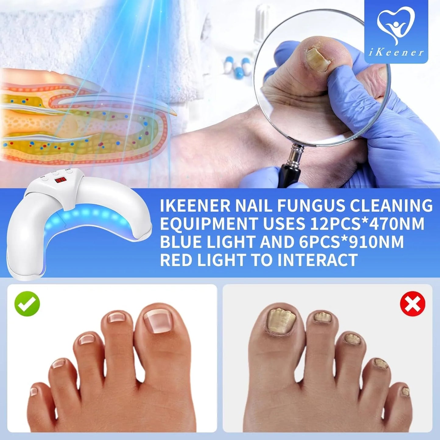 iKeener Nail Fungus Laser Device 8x910nm 14x470nm Cure Onychomycosis Toenail Fingernail Fungal Therapy Device Time display